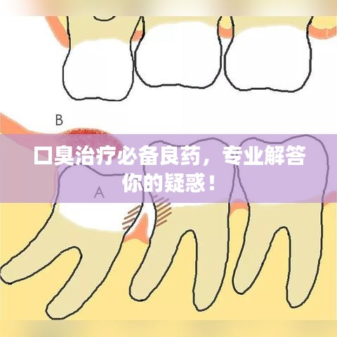 口臭治疗必备良药，专业解答你的疑惑！